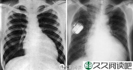 45°角折射出左心室的忧伤
